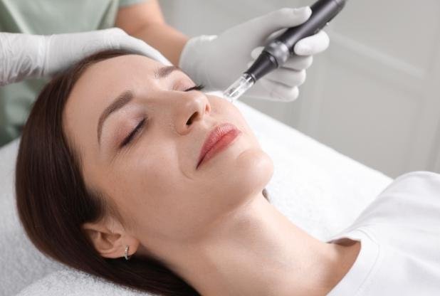 Microneedling treatment in Beaconsfield, Buckinghamshire