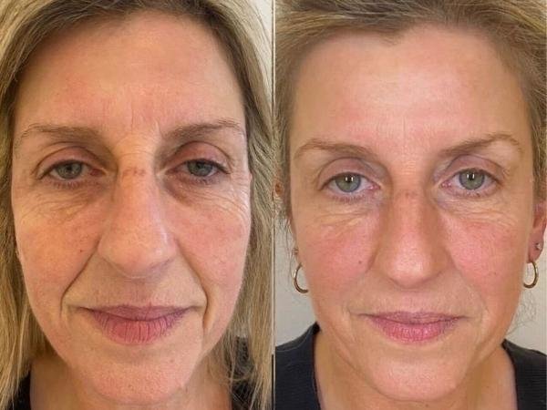 aAesthetics Treatment Results Beaconsfield Full Face Transformation Results from Sculpt in Buckinghamshire
