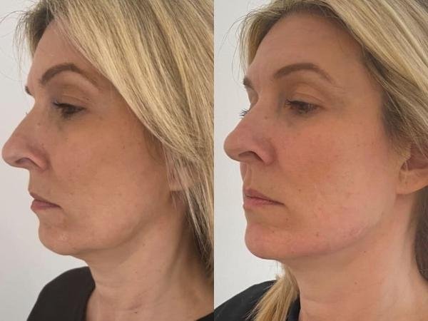 Aesthetics Treatment Results for Jowls Aesthetics Treatment Results for Jowls