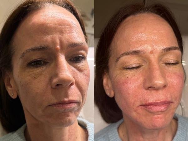 Full Face Transformation Results from Sculpt in Buckinghamshire Full Face Transformation Results from Sculpt in Buckinghamshire