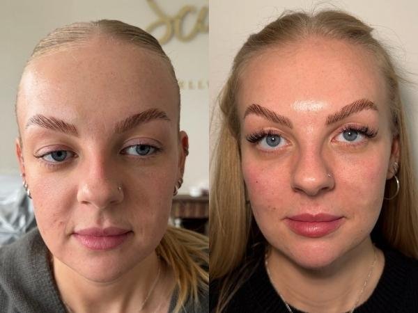 Glowing Before and After Results as Buckinghamshire Skin Clinic Sculpt Glowing Before and After Results as Buckinghamshire Skin Clinic Sculpt