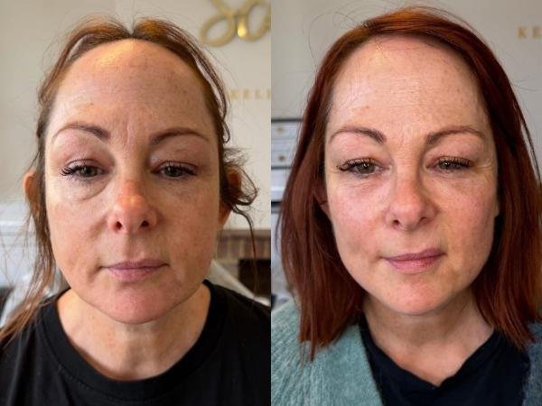 Gorgeous Patient Transformation at Sculpt by Kelly Swann Gorgeous Patient Transformation at Sculpt by Kelly Swann