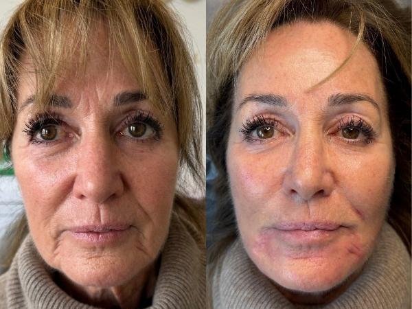 Lower Face Rejuvenation for Beaconsfield Client at Sculpt by Kelly Swann Lower Face Rejuvenation for Beaconsfield Client at Sculpt by Kelly Swann