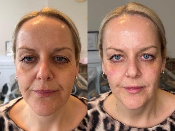 Rejuvenation Treatments at Sculpt by Kelly Swann Aesthetics Clinic