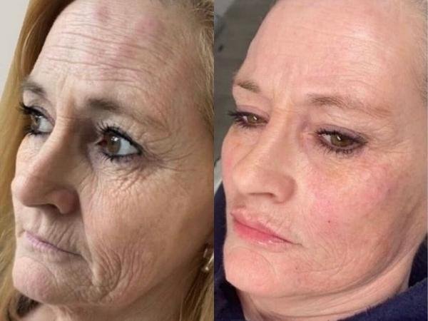 Skin Transformation in Beaconsfield Aesthetics Clinic Skin Transformation in Beaconsfield Aesthetics Clinic