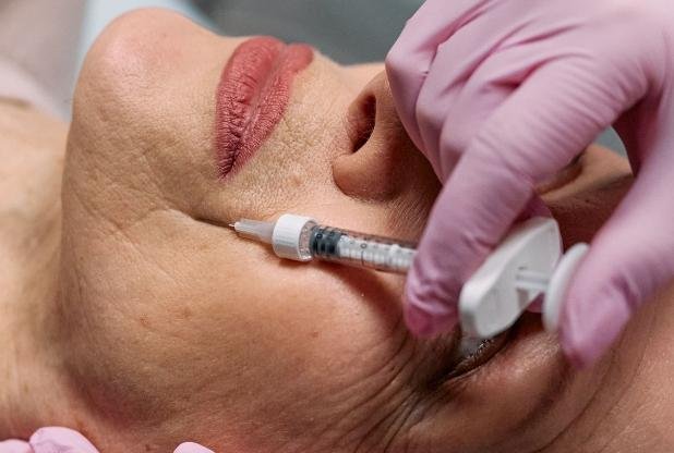 Marionette line filler in Beaconsfield, Buckinghamshire clinic