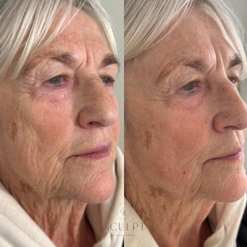 Sculptra before and after results by Sculpt by Kelly Swann in High Wycombe