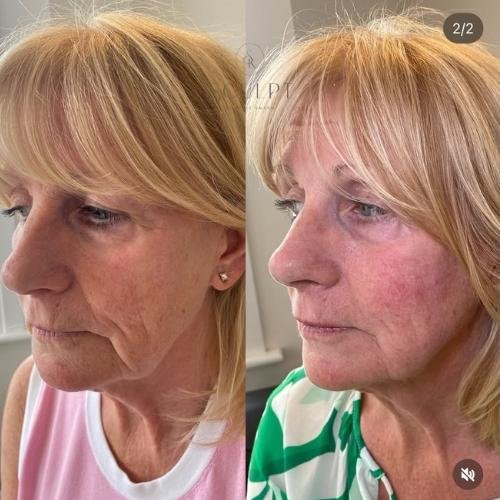Sculptra before and after results by Sculpt by Kelly Swann in Buckinghamshire