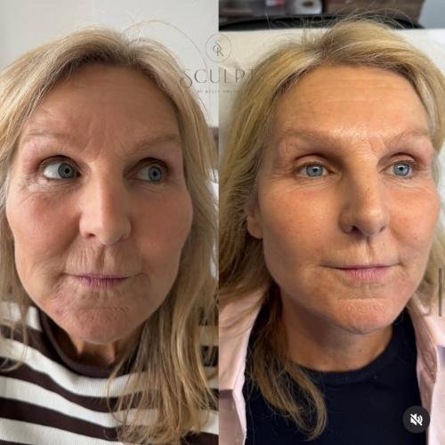Sculptra before and after results by Sculpt by Kelly Swann in Beaconsfield