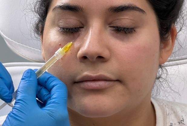 Tear trough filler in Beaconsfield, Buckinghamshire clinic