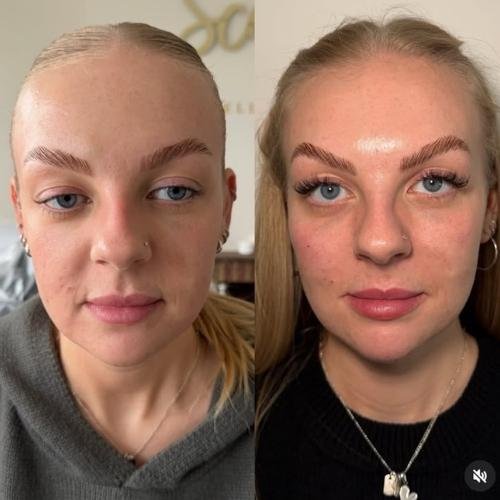 5ml cheek filler transformation in Beaconsfield