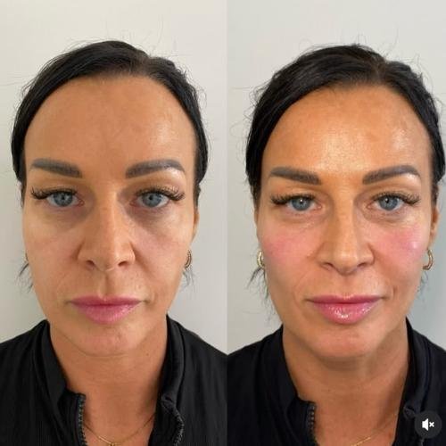 Cheek filler in Beaconsfield, Buckinghamshire