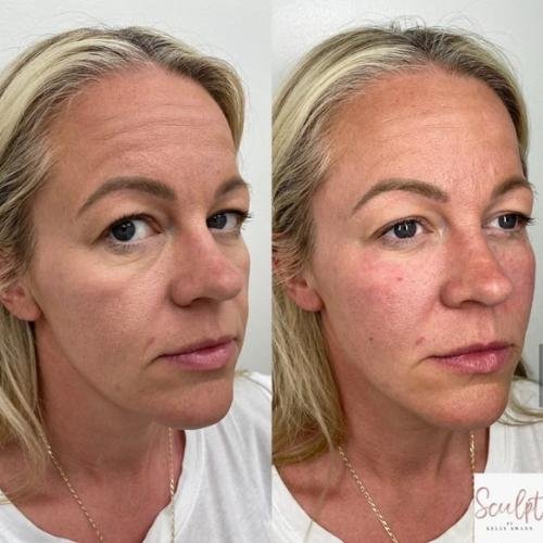 Cheek filler Beaconsfield
