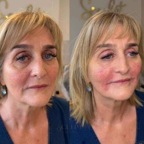 Marionette line filler Beaconsfield