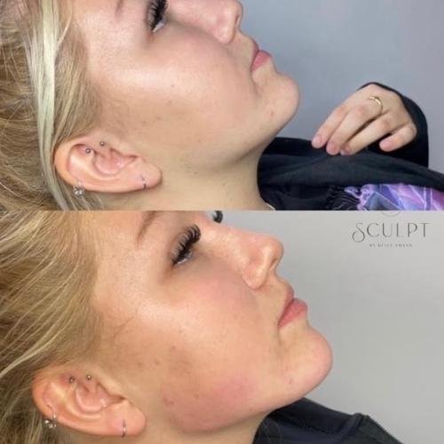 jaw-filler-beaconsfield Jaw filler in Beaconsfield