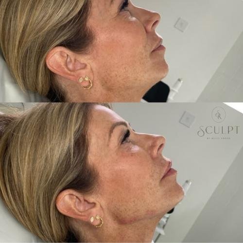 jaw-filler-buckinghamshire Jaw filler in Beaconsfield, Buckinghamshire