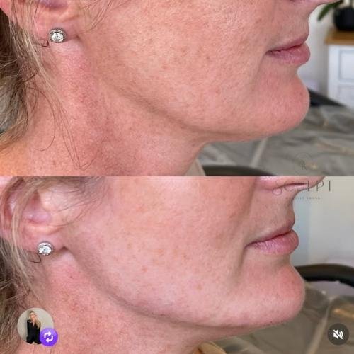 jawline-filler-beaconsfield