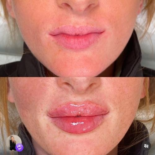 Lip correction with lip filler in Beaconsfield, Bucks