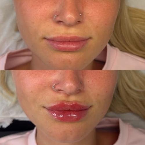 Lip filler in Beaconsfield, Buckinghamshire