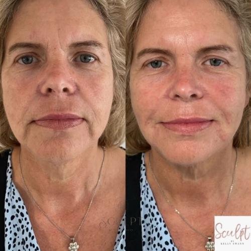 Mouth to chin filler (Marionette line filler) Beaconsfield