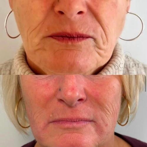 Nasolabial folds filler (nose to mouth lines) Beaconsfield