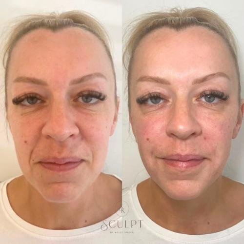 Nasolabial fold line filler Beaconsfield