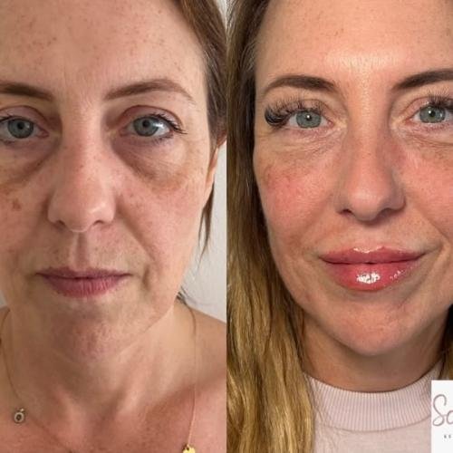 Subtle lip enhancement with lip filler in Beaconsfield