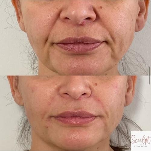 Nasolabial folds filler Beaconsfield