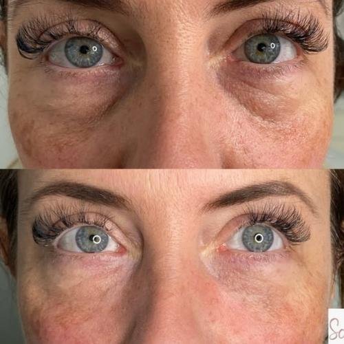 under-eye-filler-in-beaconsfield Under-eye filler (tear trough filler) in Beaconsfield