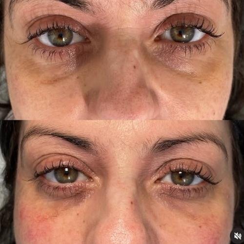 under-eye-rejuvenation-with-tear-trough-filler-in-buckinghamshire Under-eye rejuvenation with tear trough filler in Beaconsfield, Buckinghamshire