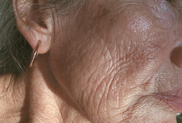 Women with crepey skin in Beaconsfield waiting for treatment