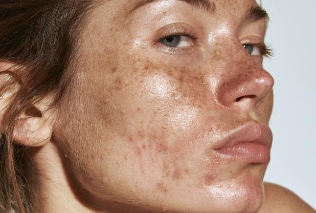 30 year old woman in Beaconsfield with uneven skin texture