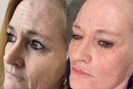 Skin Transformation in Beaconsfield Aesthetics Clinic Skin Transformation in Beaconsfield Aesthetics Clinic