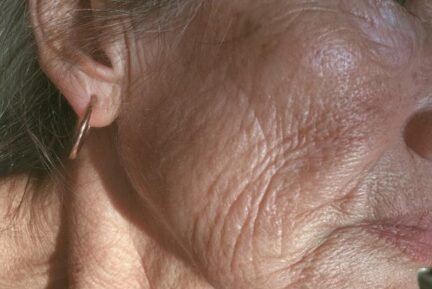 crepey-skin Women with crepey skin in Beaconsfield waiting for treatment