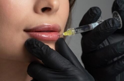 Lip filler in Beaconsfield model photo