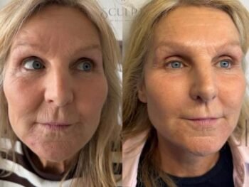 sculptra-before-and-after-result-in-beaconsfield Sculptra before and after results by Sculpt by Kelly Swann in Beaconsfield