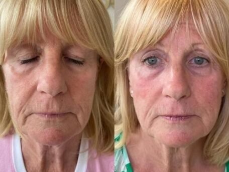 sculptra-treatment-before-and-after-result-by-sculpt-by-kelly-swann-in-beaconsfield