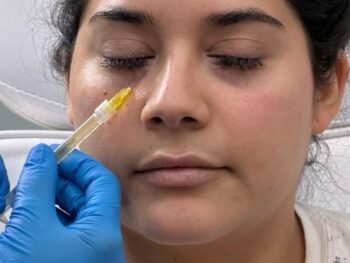 tear-trough-filler-in-bucks Tear trough filler in Beaconsfield, Buckinghamshire clinic