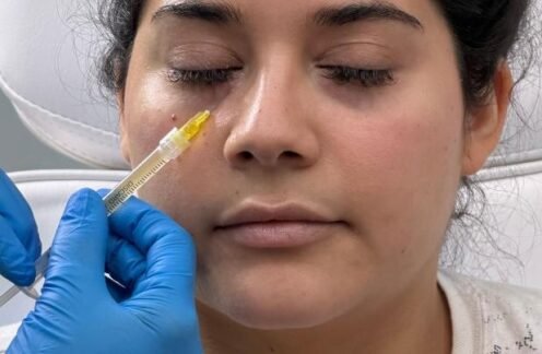 Tear trough filler in Beaconsfield, Buckinghamshire clinic